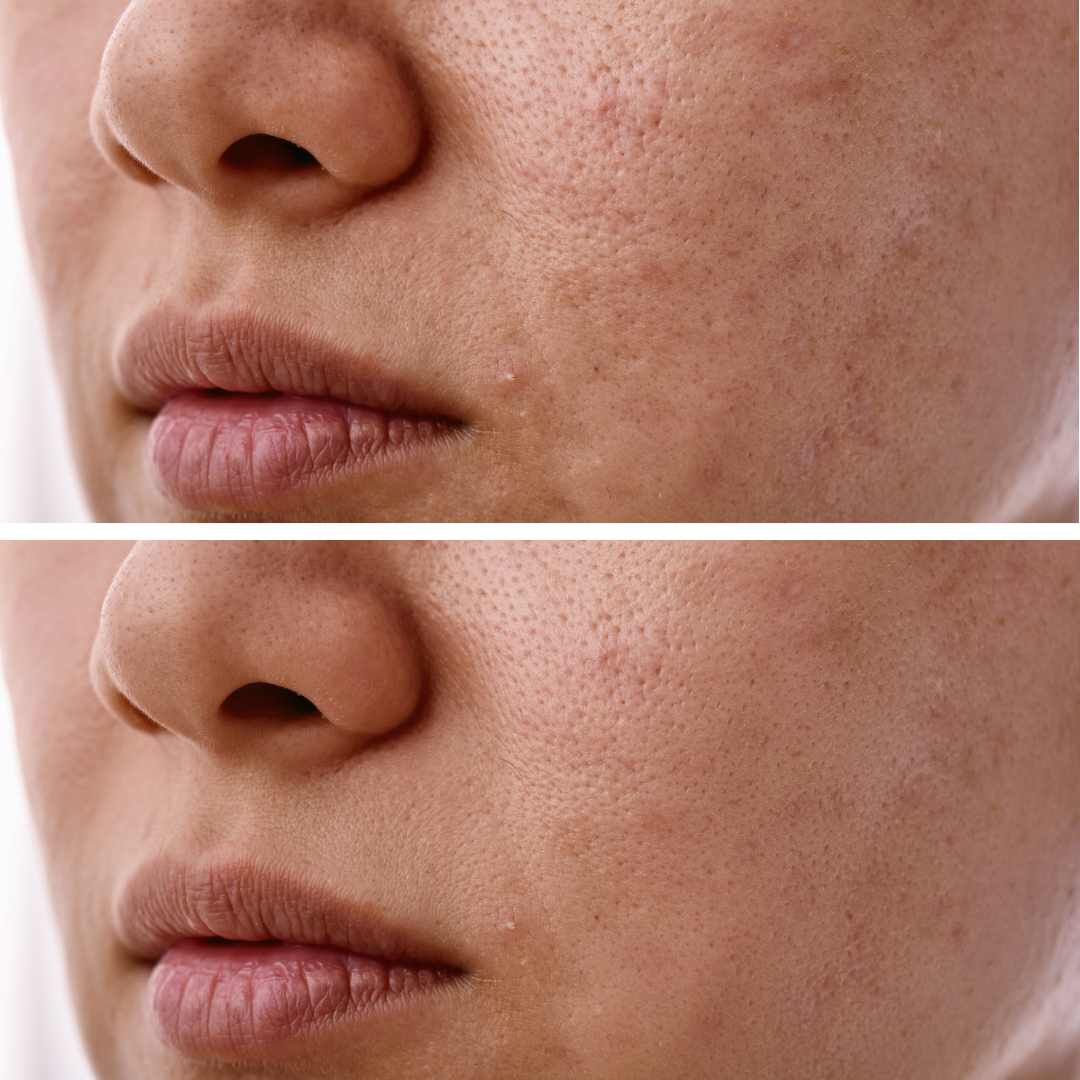 光フェイシャル症例