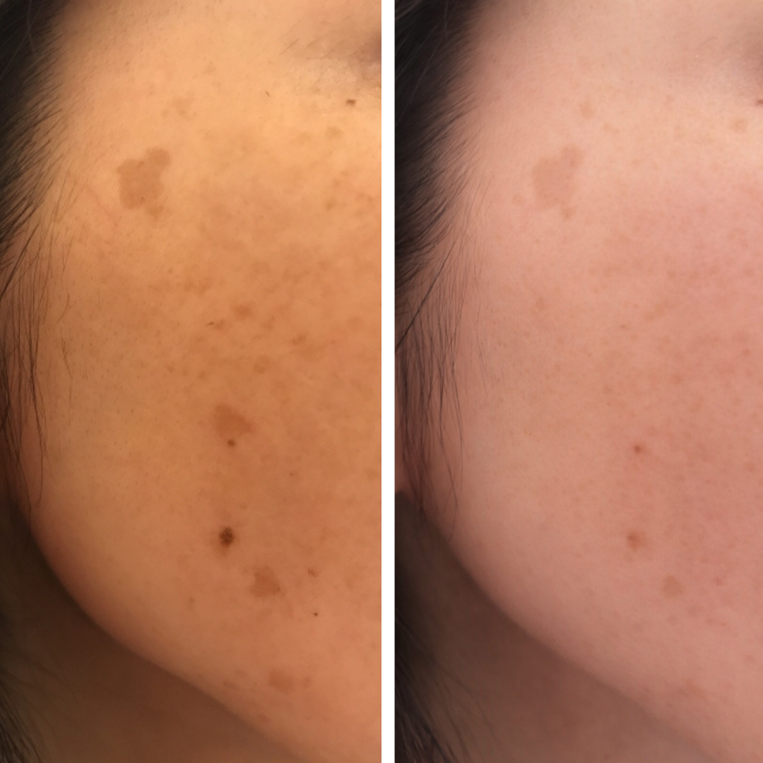 光フェイシャル